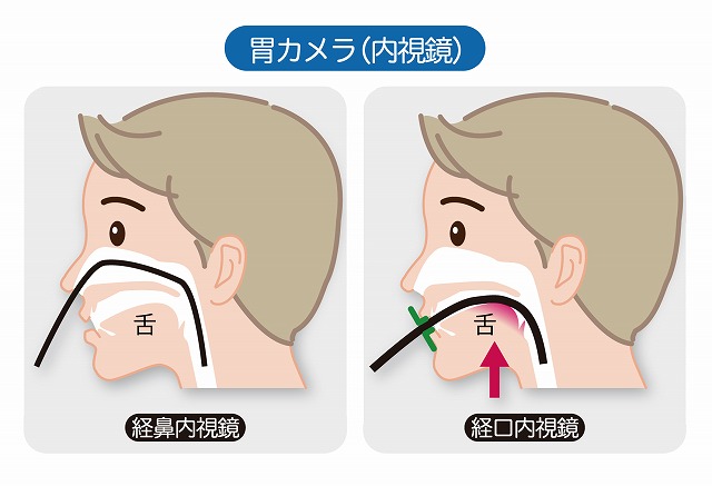 経口胃カメラ検査・経鼻胃カメラ検査を選択できる