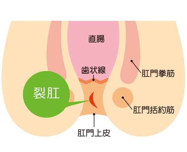 切れ痔（裂孔）