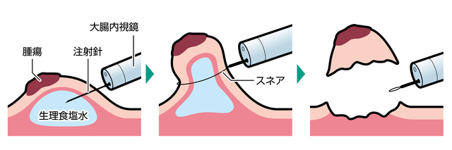 内視鏡的粘膜切除術