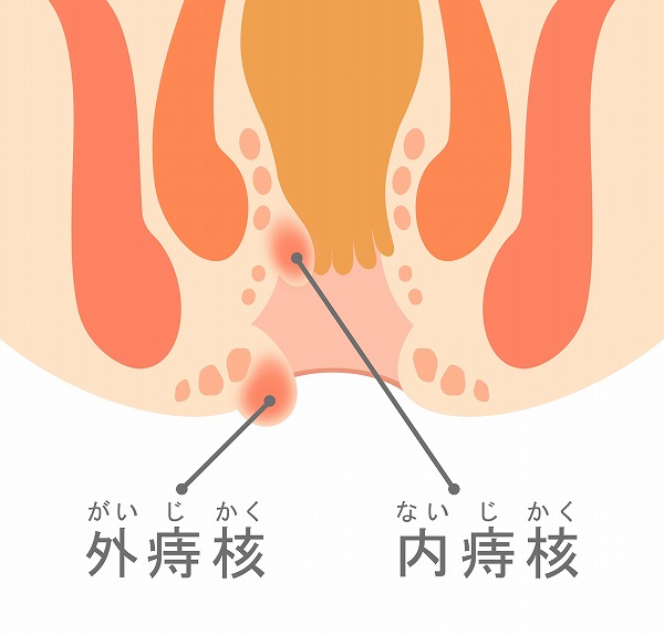 いぼ痔（内痔核・外痔核）